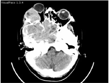 Figure 16 : TDM crânio-orbitaire 