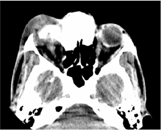 Figure 17: TDM orbito-cérébrale en coupe axiale, fenêtre parenchymateuse    