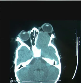 Figure 20 : TDM et IRM crânio-orbitaires     