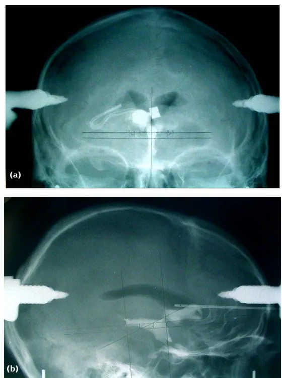 Figure 12 : Radiographie du crâne de face (a) et de profil (b) montrant la ventriculographie: mise  en évidence des ventricules latéraux, du troisième ventricule et du diagramme de Talairach et 