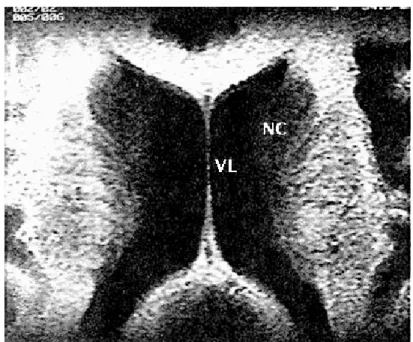 Figure 13 : coupe IRM axiale passant par les noyaux caudés (NC). 