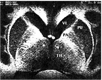 Figure 15 : coupe IRM  axiale mettant en évidence les signaux différents du putamen (PU) et du  pallidum (PA)