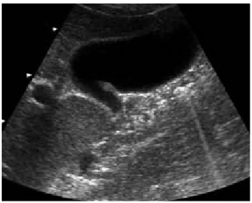 Fig. 3 : Aspect échographique d’une paroi vésiculaire normale. (32) 