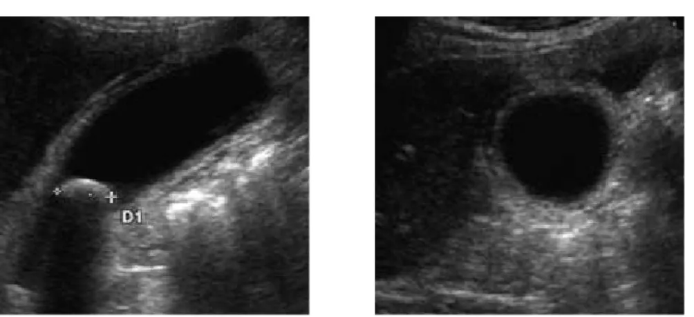Fig. 8: Cancer vésiculaire : Aspect échographique   et corrélation macroscopique. (32)