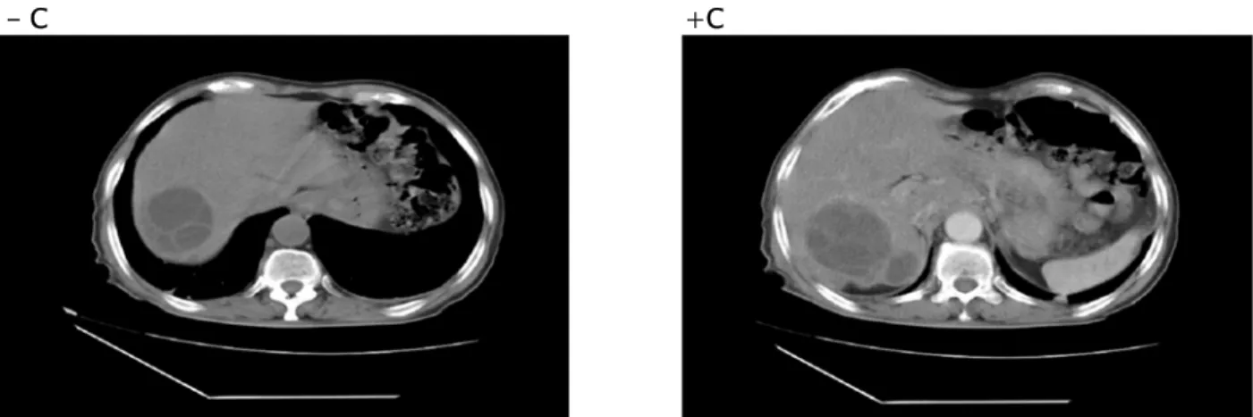 Figure 16: Images scannographiques d’un kyste hydatique du foie multi cloisonné fistulisé dans la voie  biliaire et responsable d’une PA