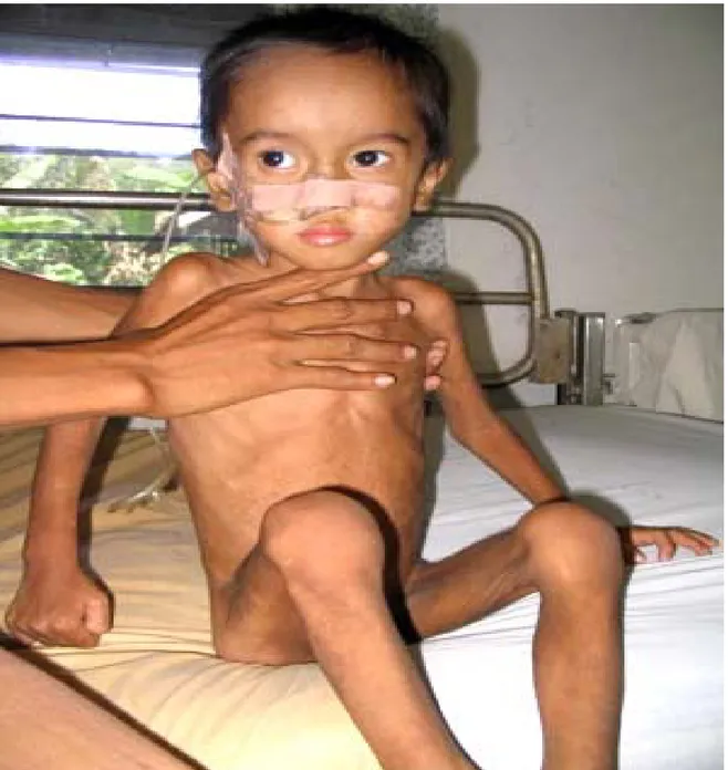 Figure 8 : Signes de dénutrition chez un grand enfant atteint de maladie coeliaque . 