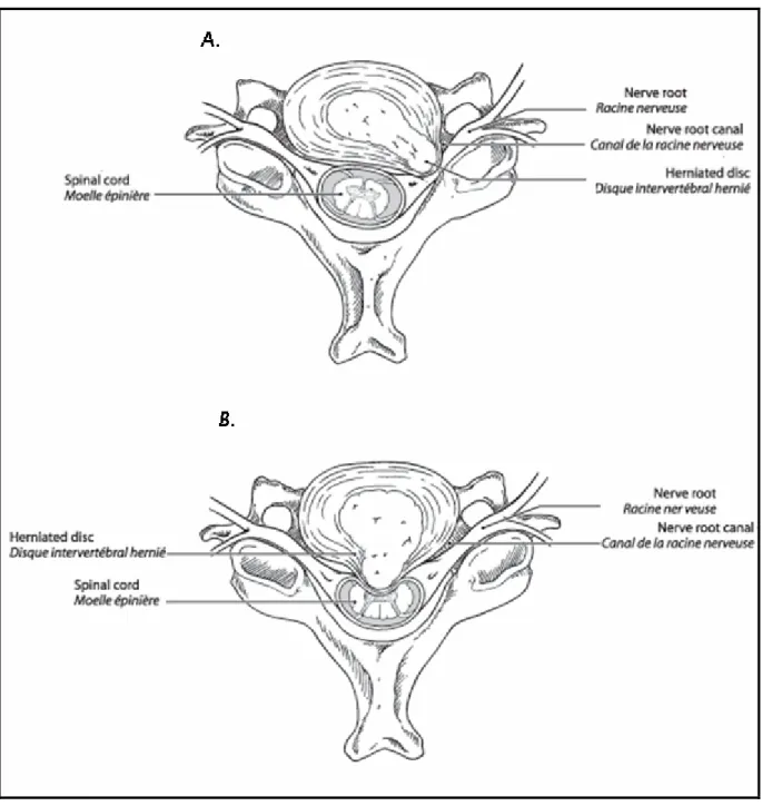 Figure n°22 : Coupe de la colonne cervicale au niveau d’un disque intervertébral hernié  (44).