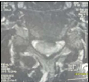 Figure n°30: IRM coupe sagittale pondérée T1 montrant une hernie discale cervicale bi- bi-étagée C5C6 et C6C7