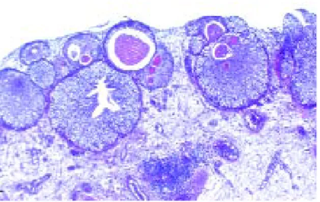 Figure 1e : Nids de von Brünn : îlots de cellules urothéliales  nés du revêtement épithélial de surface et dont certains sont 