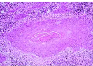 Figure 2 :Carcinome épidermoïde de vessie. Grossissement  oculaire 25. Plage de cellules épithéliales tumorales présen -  tant une différenciation malpighienne et des phénomènes de  kératinisation au sein d’un chorion remanié par des phéno - 