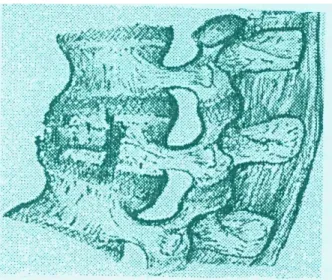 Figure 12 : Fracture-compression.