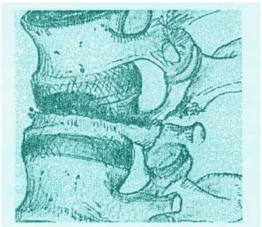 Figure 15 : Fracture-dislocation. 