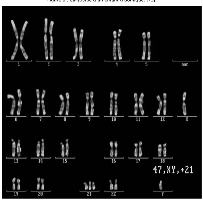 Figure 6 : Caryotype d’un enfant trisomique. [79]. 