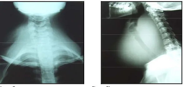 Figure 7 : Patient qui présente un goitre multinodulaire plongeant et compressif 