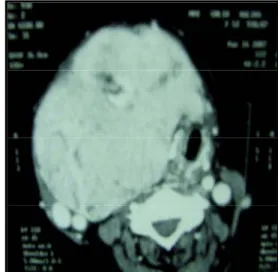 Figure 9a : Radiographie du thorax face montrant  une opacité prédominant sur le lobe droit