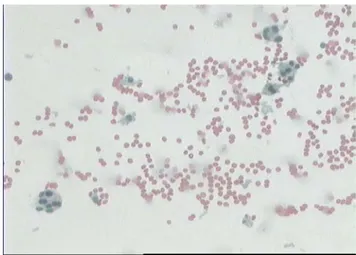 Fig  12 : Cellules épithéliales organiséés en amas   sur un fond hémorragique (HEx100) 