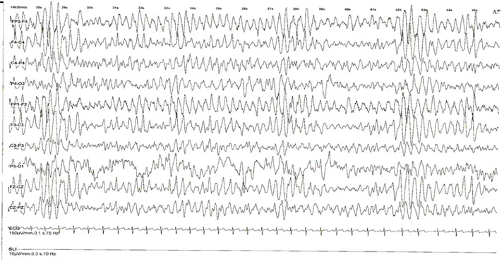 Figure n°12 : Eléctroencéphalogramme intercritique montrant des décharges de polypointes  ondes bilatérales et symétriques chez un garçon de 8 ans présentant une épilepsie 