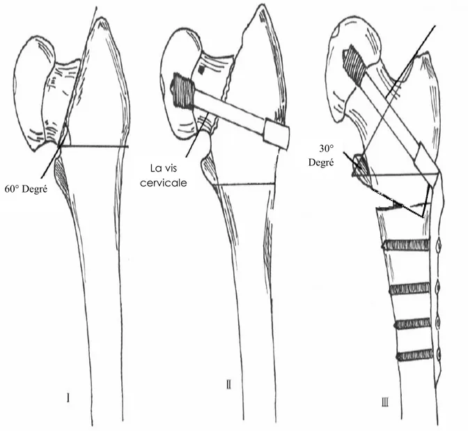 Figure n°2: Notre technique d’ostéotomie de valgisation montée sur DHS 60° Degré La vis cervicale 30° Degré 