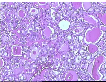 Figure 14:  [G×200 HE]. Prolifération de cellules carcinomateuses agencées en vésicules de taille  variable
