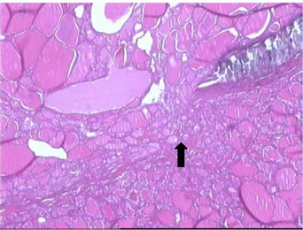 Figure 16: [G×40 HE].  Prolifération carcinomateuse agencée en vésicules de taille variable