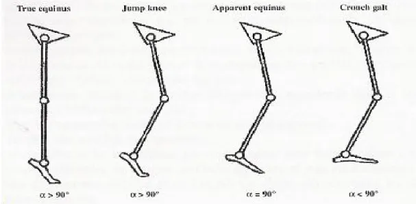 Figure 11 : Classification de la marche du diplégique spastique selon Rodda et Graham (55) 