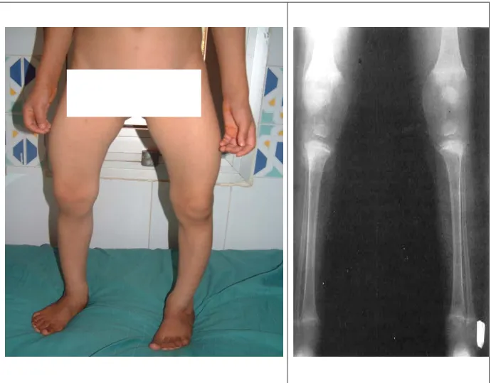 Figure 41 : Photo et radiographie des membres inférieurs d’enfants rachitiques   suivis au CHU Mohamed VI 