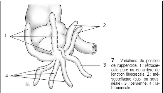 Figure 1 : Schéma montrant les variations anatomiques de l’appendice 