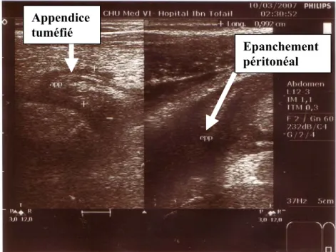 Figure 7 : Image échographique montrant un appendice tuméfié associé à un épanchement  péritonéal pouvant correspondre à une péritonite appendiculaire 