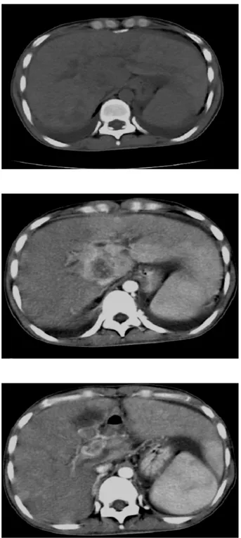 Figure 8 : CHC nodulaire typique sur foie sain probable, Thrombose porte et dilatation des voies  biliaires intrahépatiques  