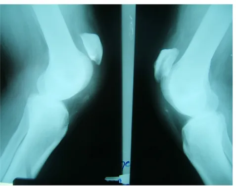 Figure 16 : Cliché d’IRM montrant la rupture du tendon patellaire gauche 