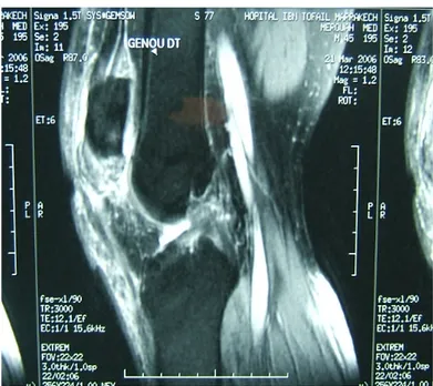 Figure 17 : Cliché d’IRM montrant la rupture du tendon patellaire droit 