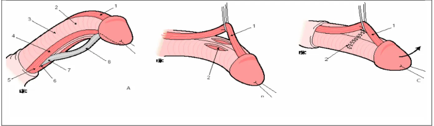 Figure 11 : Plastie dorsale des corps caverneux (Nesbit). 