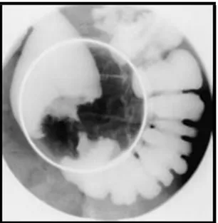 Figure 26: Aspect d’une tumeur colique végétante et infiltrante circonférentielle   et sténosante du colon sur un lavement baryté 