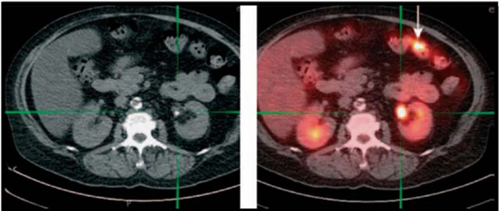 Figure 30: Cancer du colon gauche de petite taille révélé par le PET-scan 