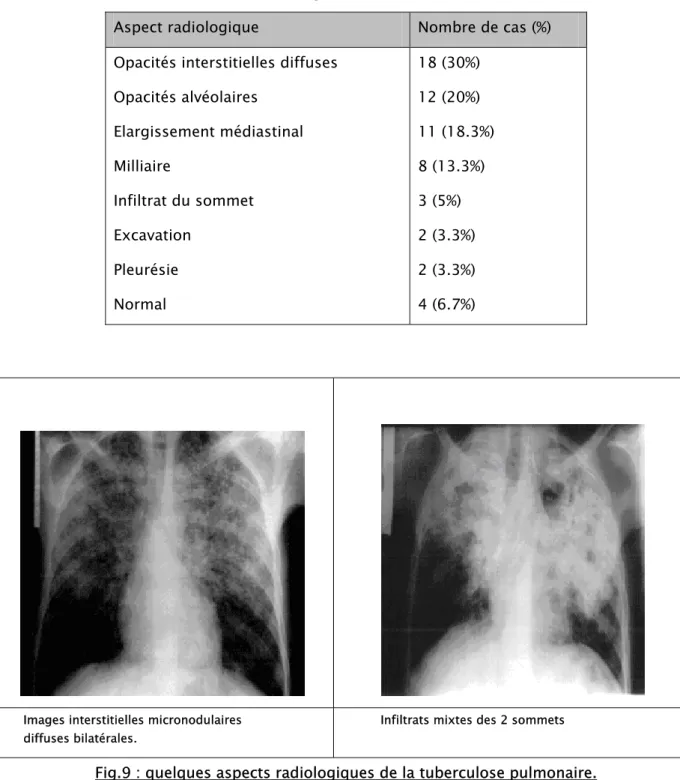 Tableau XI : Aspects radiologiques de la tuberculose pulmonaire.  Aspect radiologique  Nombre de cas (%)  Opacités interstitielles diffuses 