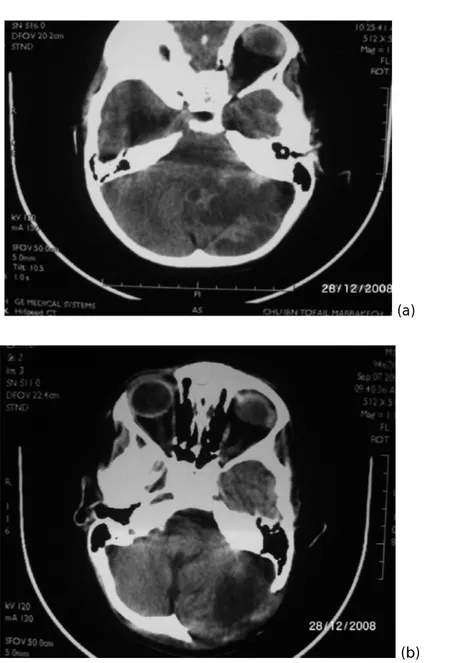 Figure 5 : TDM cérébrale en coupe axiale avec injection de produit de contraste (a) montrant un                 médulloblastome et son contrôle après exérèse chirurgicale (b)