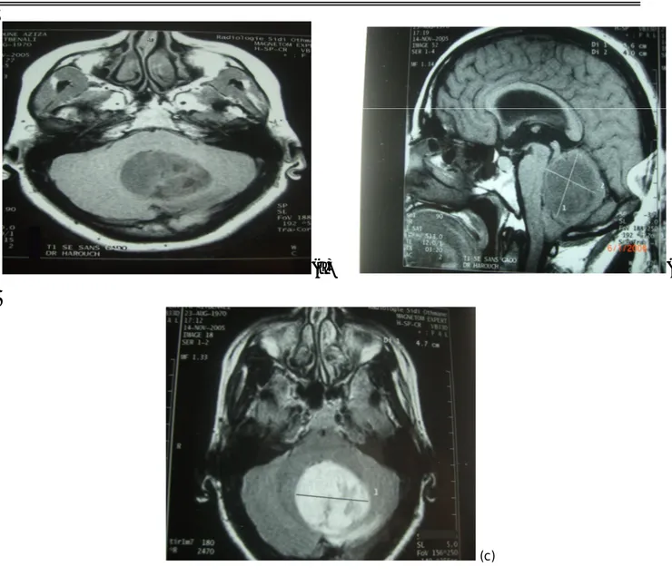 Figure 7 : IRM Cérébrale préopératoire en séquence pondérée T, sans injection de gadolinium en  coupe  axiale  (a)  et  sagittale  (b)  et  après  injection  de  gadolinium  en  coupe  axiale  (c)  en  T1  montrant un médulloblastome