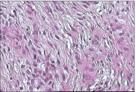 Figure n°19 : Tumeur phyllode de grade 2 avec un contingent stromal dense fait de cellules  fusiformes réguliers ( HE x200)