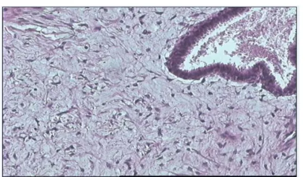 Figure n°20 : Tumeur phyllode de grade 1 : Le contingent épithelial est pseudostratifié régulier