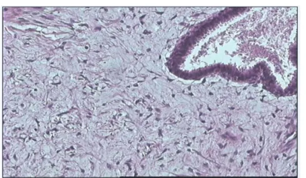 Figure n°20 : Tumeur phyllode de grade 1 : Le contingent épithelial est pseudostratifié régulier