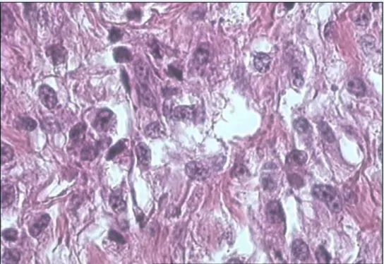 Figure n°23 : Sarcome pyllode : Le contingent stromal est très cellulaire, fait de cellules  pléomorphes avec un index mitotique élevé (HEx200)