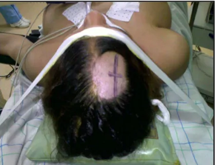 Figure 4 : Installation du patient, vue crâniale du tracé de l’incision. 