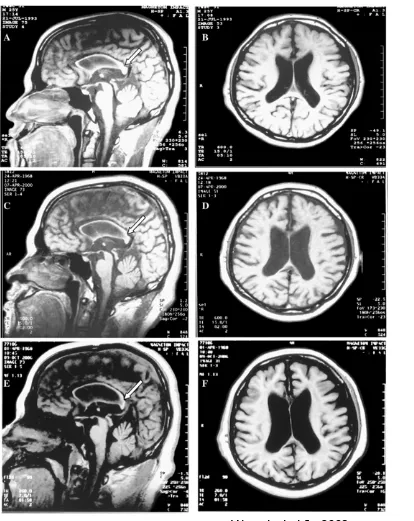 Figure 9 : IRM cérébrale montrant une atrophie progressive du corps calleux:  A, 1993; C, 2000; E, 2006