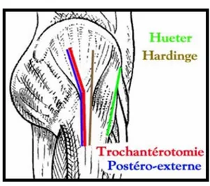 Figure 14 :  Le tracé de l’incision cutanée des différents voies d’abord de la hanche (2) 