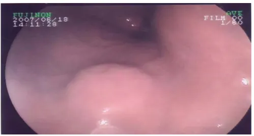 Figure 7 : Formation d’allure sous muqueuse centrée par une ulcération  au niveau de la petite courbure évoquant une tumeur stromale