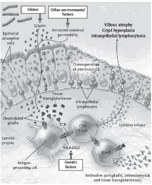Figure n° 4 : Interaction du gluten avec des facteurs environnementaux, immunologiques, et  génétiques dans la maladie coeliaque [16]  