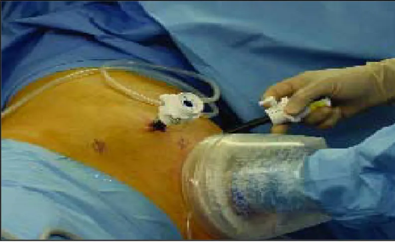 Figure 29 : Appareillage hand port au cours d’une néphrectomie manuellement assistée 