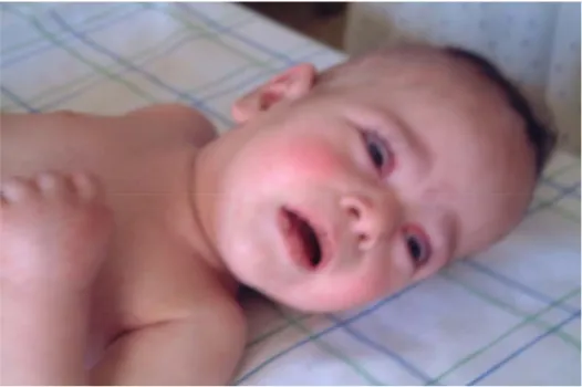 Figure 4 : Enanthème et exanthème chez un malade de 6 mois 