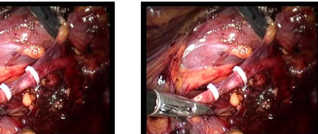 Figure 12 : Libération de l’uretère             Figure 13 : Contrôle de l’uretère par 2  clips hemo-look 