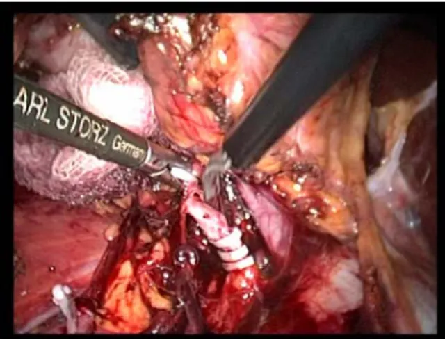 Figure 17 : Section de l’artère rénale   *Cinquième étape : Dissection veineuse (fig.18-21) : 